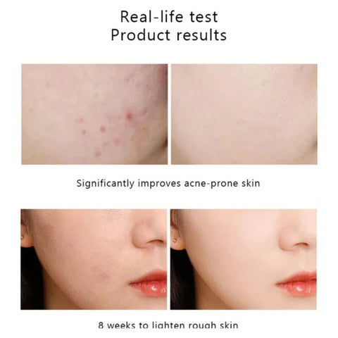 Anti Acne
